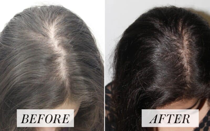 WHAT IS THE COST OF A PRF HAIR STIMULATION THERAPY?